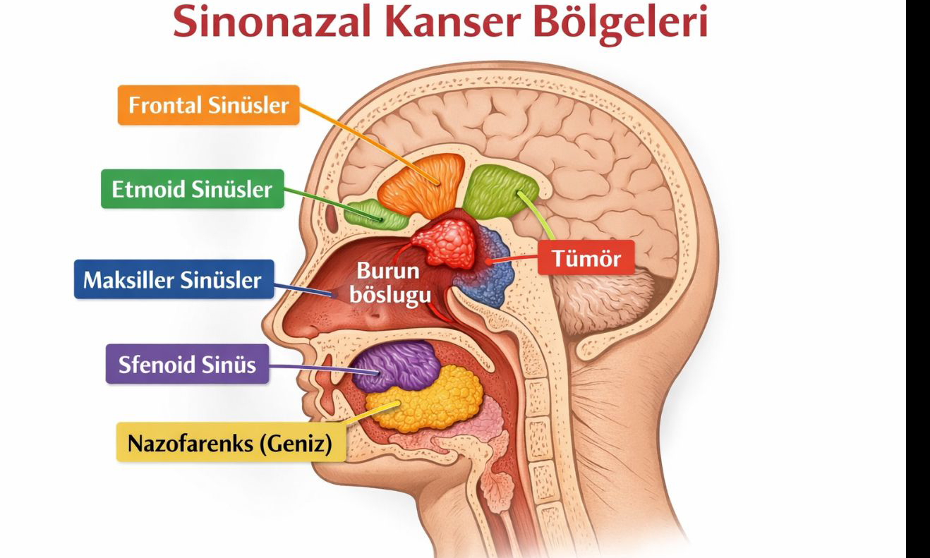 Sinonazal kanserler